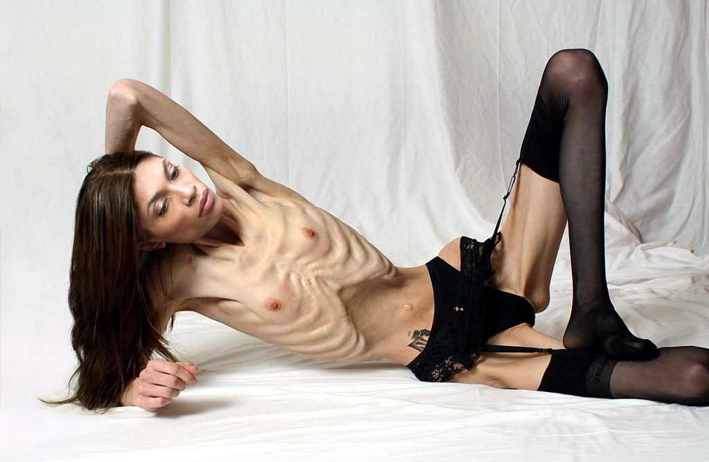 anorexia.jpg