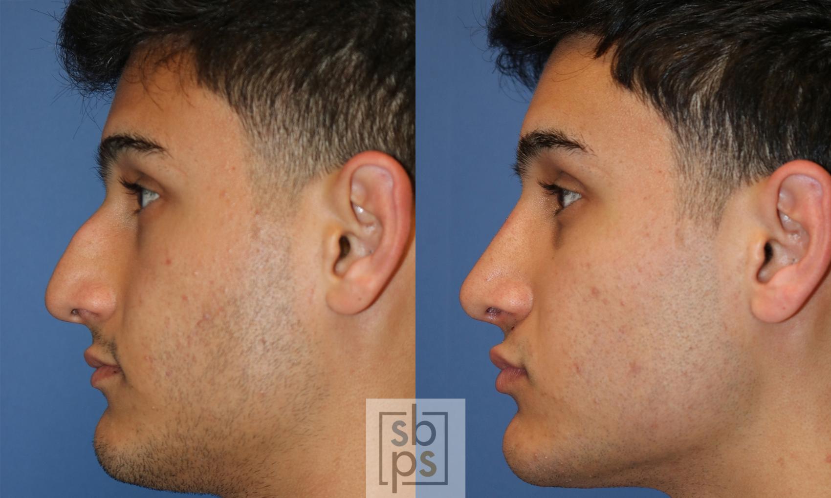 nose-surgery-rhinoplasty-429-left-side-detail.jpg