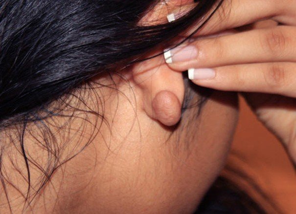 lump-in-earlobe-pictures-2.jpg