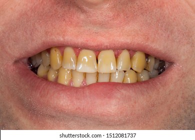 smoking-plaque-on-teeth-human-260nw-1512081737.jpg