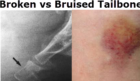 96-966777_bruised-tailbone-vs-broken-tailbone-bruised-tailbone.png