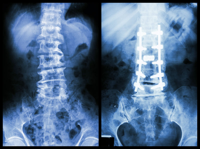 spine-surgery.jpg